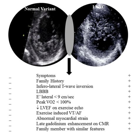 left ventricular trabeculation